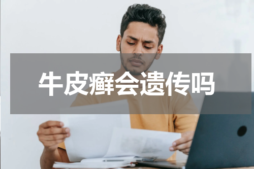 牛皮癣会遗传吗
