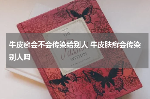 牛皮癣会不会传染给别人 牛皮肤癣会传染别人吗